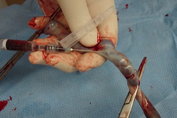 臍帯動脈血の採取